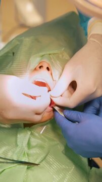 Dentist using surgical pliers to remove a decaying tooth in stomatology room