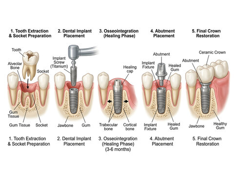 Dental implant procedure step by step illustration isolated on white background