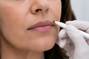 Naklejka premium Practitioner Drawing Dotted Injection Mapping Lines Around Lips of Female Patient With Surgical Marker Before Lip Filler Procedure