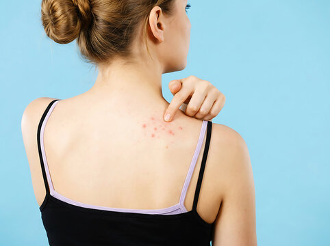 Woman pointing at red pimples on her back against a blue background acne skin
