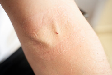 Naklejka premium Close-up of an injection mark and medical plaster trace on the inner elbow skin