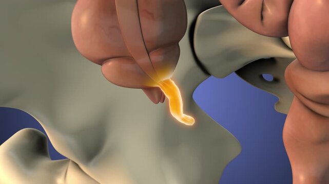 Acute Appendiceal Inflammation and Pain