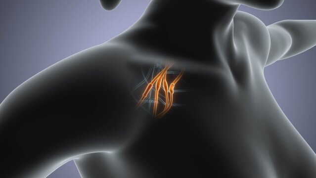 Brachial Plexus Nerve Swelling Syndrome