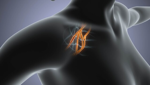 Brachial Plexus Nerve Swelling Syndrome