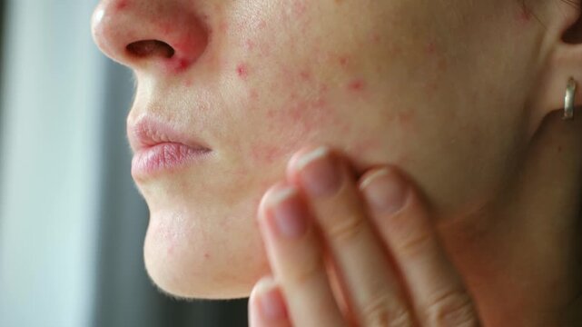 Close up woman face with red rash, pimples, post acne scars, touching her cheek. Dermatological problems, allergies, skin care concepts for sensitive skin. Woman with skin problem touching face rash