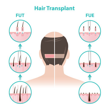 Comparison FUT and FUE hair transplant procedure with bald man illustration. Remove a strip of scalp, divided into small grafts vs extract hair grafts one by one and transplanted into the target area.