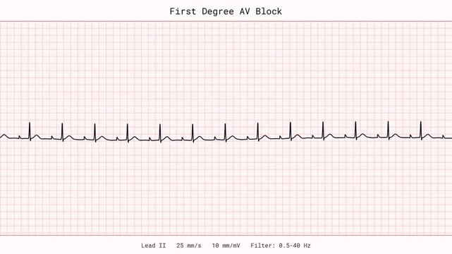 First Degree AV Block Heart Block PR Interval Conduction Delay Arrhythmia ECG EKG Monitor 4K Medical Video Cardiology Clinic Vital Signs Patient Tracing Healthcare Heart Disease Clinical Display