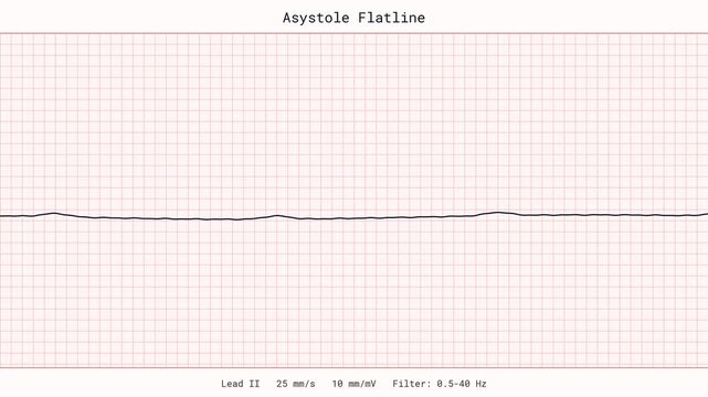 Asystole Flatline Cardiac Arrest Death Code Blue Emergency Fatal ECG EKG Monitor 4K Video Cardiology Clinic Vital Signs Patient Tracing Healthcare Critical Care Passing Away Animation Display UI