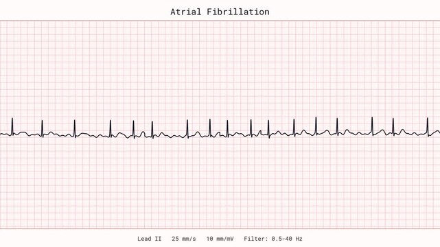 Atrial Fibrillation AFib Irregular Heartbeat ECG EKG Monitor 4K Medical Video Arrhythmia Cardiology Clinic Vital Signs Patient Tracing Healthcare Heart Disease Stroke Risk Palpitation Animation