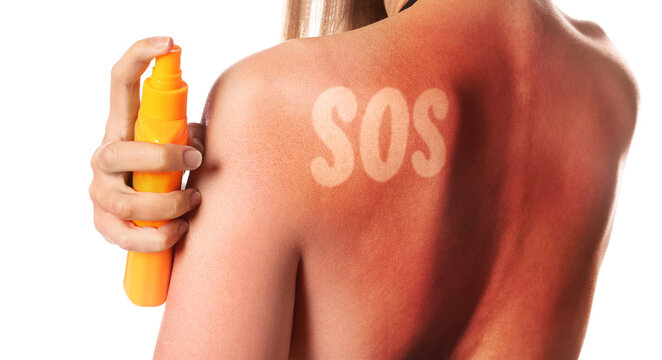 Woman with red sunburned skin applying after-sun product against white background, back view