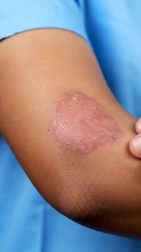 Close-Up Of An Inflamed Eczema Patch On An Elbow Showcasing Skin Texture, Set Against A Plain Blue Background For Medical and Educational Use