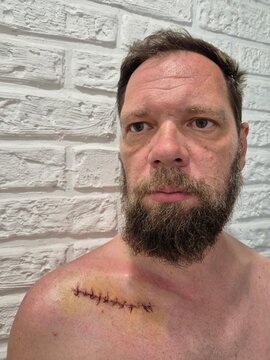 surgical suture on a man's shoulder.