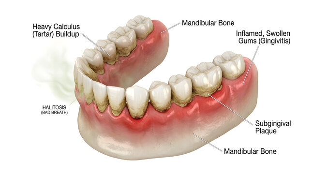 Dental model showing halitosis and gingivitis