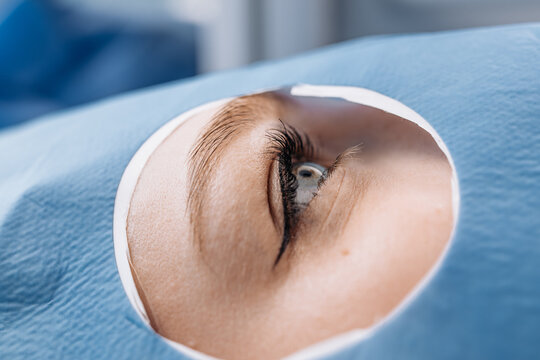 Patient's eye visible during microsurgery procedure, surrounded by sterile blue drapes and surgical instruments in a clinical operating room environment