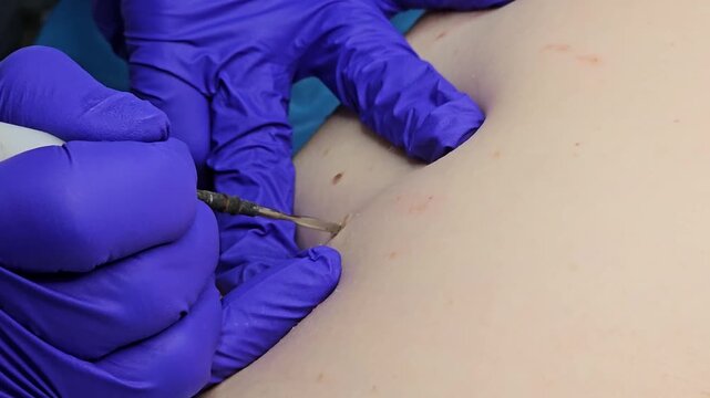 Doctor removing small papillomas with electrocoagulator during dermatology procedure in clinic