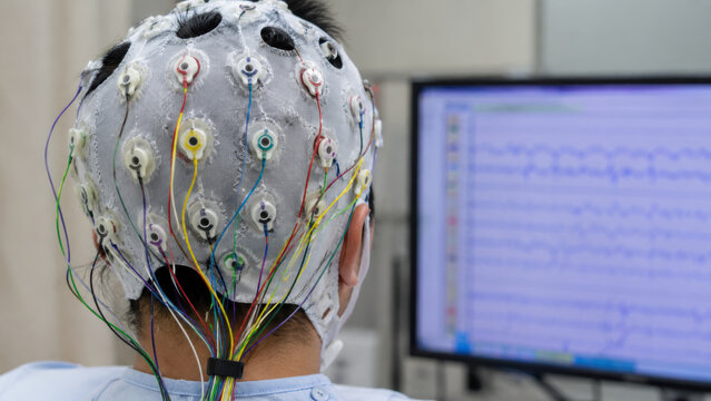 Epilepsy, EEG. Back view of a patient wearing an EEG electrode cap with multiple colored wire leads attached at standard scalp positions