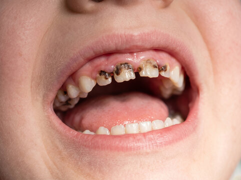 Severe early childhood caries