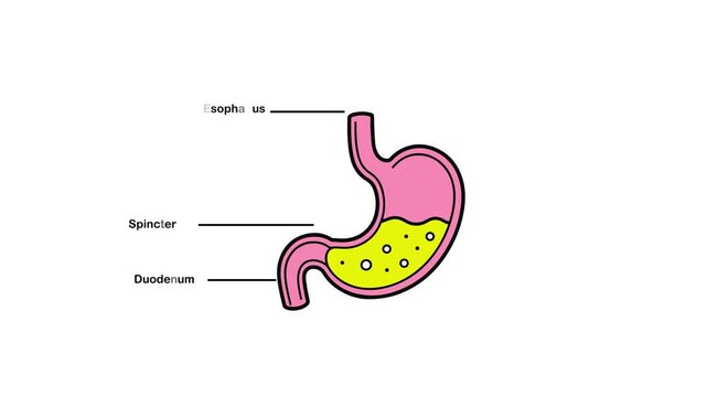 Simplified medical diagram of a pink and yellow stomach with labeled esophagus, sphincter, and duodenum, showing digestive fluid with bubbles on a white background, clear and educational rep