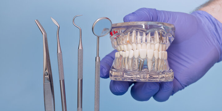 Dental Implant Jaw Model with Dentist Tools in Blue Medical Glove on Light Blue Background, Prosthetic Dentistry Concept