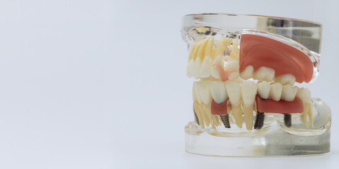 Dental Jaw Model with Implants Dentures and Prosthetic Teeth © Maximusdn