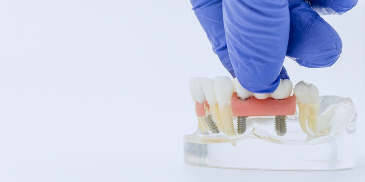 Gloved Hand Installing Implant Supported Dental Bridge on Jaw Model