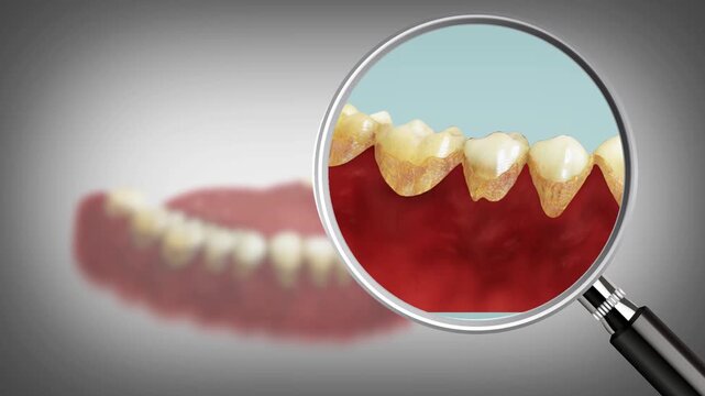 3D Animation of Periodontal Pocket Measurement and Disease Progression