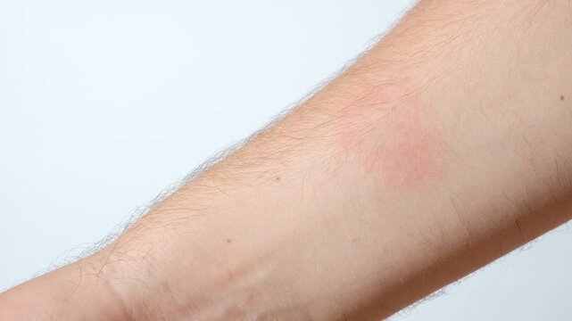 Close-up of erythema migrans rash caused by Lyme disease on patient skin.