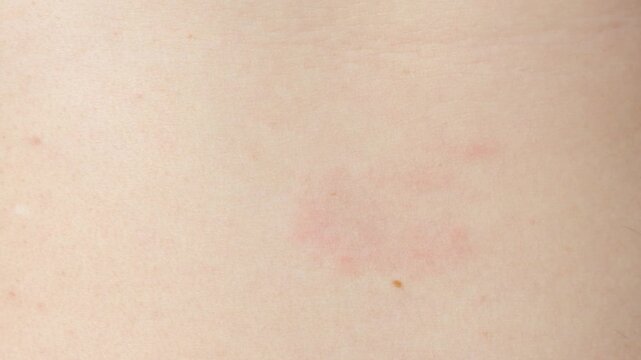 Close-up of erythema migrans rash caused by Lyme disease on patient skin
