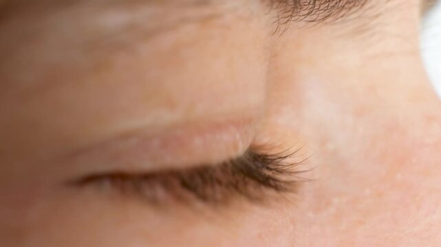 Advanced keratoconus eye disease macro profile view
