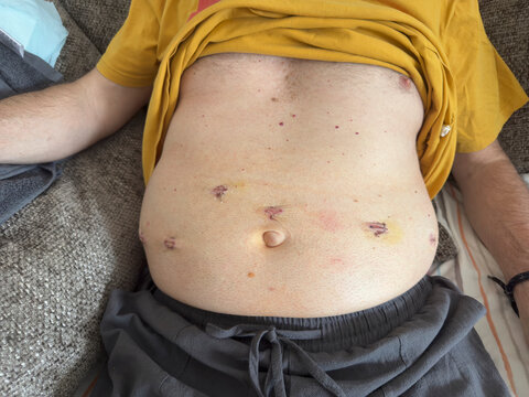 A man's stomach showing the stitched incisions made for robotic surgery. Prostatectomy.Operation.Stitches