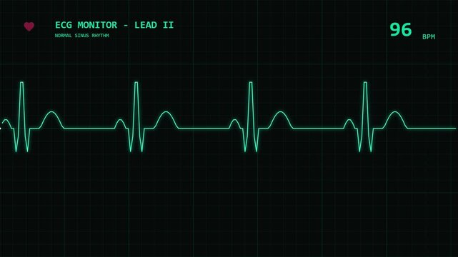 ECG Heart Monitor Display Showing Normal Sinus Rhythm Pulse Graph