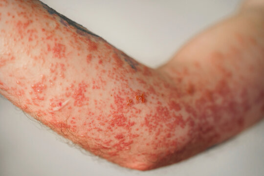 Close up of human arm showing severe skin rash with red bumps and irritation. Shingles or herpes zoster infection, painful dermatological medical condition, viral disease symptoms 