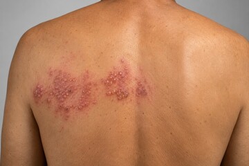 Naklejka premium Herpes Zoster Shingles Blisters Spreading Across Upper Back in Dermatomal Band Pattern on Bare Skin Against Gray Background