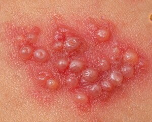 Fototapeta premium Extreme Macro Close-Up of Herpes Zoster Shingles Vesicles Showing Fluid-Filled Blisters Clustered on Inflamed Red Skin Surface