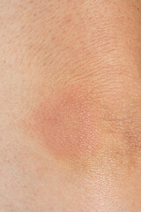 Naklejka premium Erythema migrans rash caused by Lyme disease. Borreliosis symptom