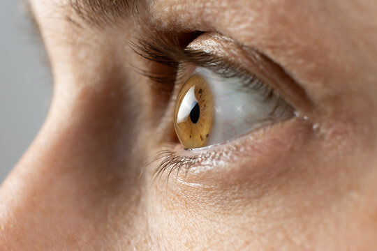 Conical cornea deformity in severe keratoconus patient