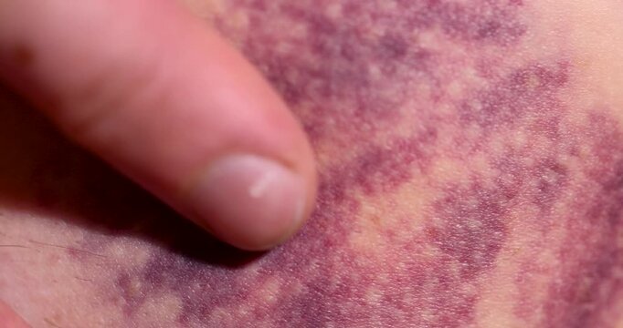 Purple hematoma on the skin, extensive hematoma appeared on the body due to rupture of small blood capillaries and vessels