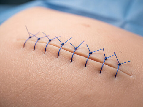 Surgical suture photo of interrupted blue stitches on skin incision wound for medical healthcare clinical use.