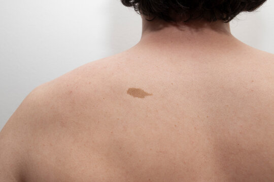 Large birthmark visible on the upper back of an adult man in a close up view. Concept of skin pigmentation, birthmarks, dermatology, skin monitoring, preventive healthcare.
