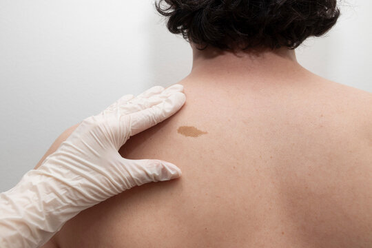 Doctor examining a birthmark on the upper back of an adult man during a skin checkup. Concept of dermatology, skin cancer prevention, medical examination, early diagnosis, healthcare.