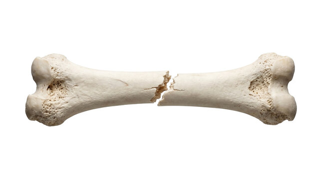 Single human bone in middle broken, isolated on transparent background with soft shadows.