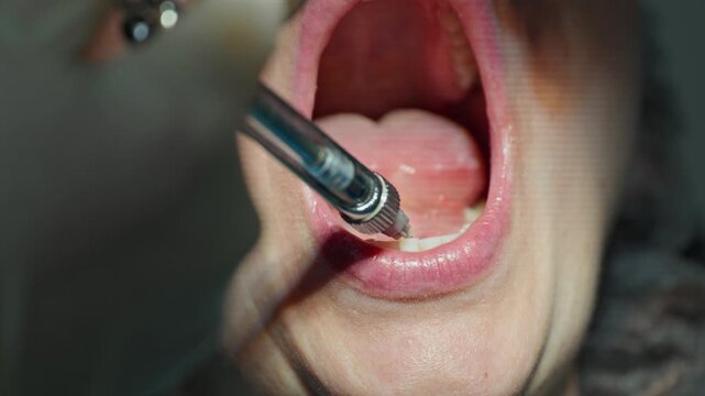 Close-up of a dentist administering anesthesia with a syringe before starting a dental implant post surgery