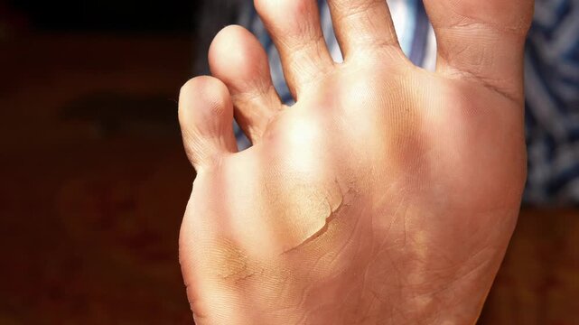Close-up of foot sole with dry, peeling skin and visible texture