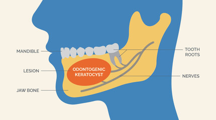 Odontogenic Keratocyst Jaw Lesion Diagram © Bima