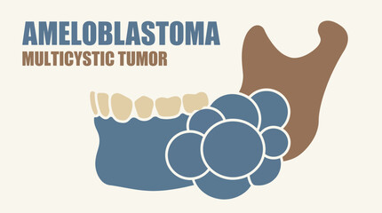 Ameloblastoma Jaw Tumor Multicystic Appearance © Bima