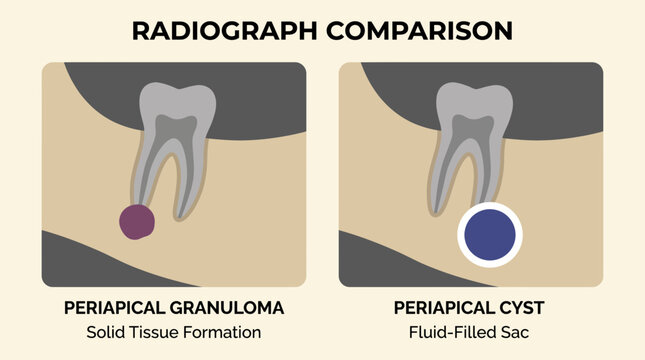 Periapical Granuloma Cyst Radiograph Comparison