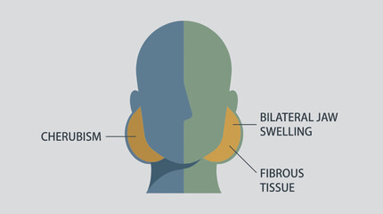 Cherubism Bilateral Jaw Swelling Fibrous Tissue © Bima