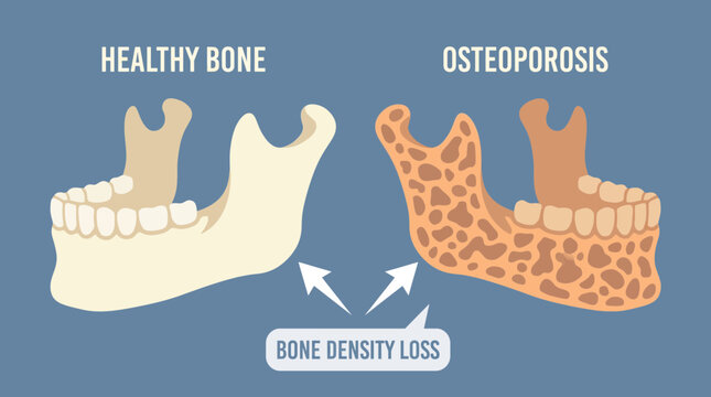 Osteoporosis Jaw Bone Density Loss Illustration