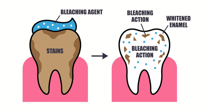 Tooth Whitening Bleaching Mechanism Illustration