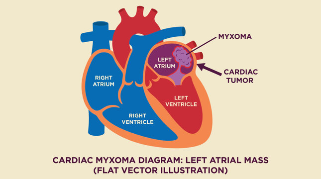 Cardiac Tumor Myxoma Left Atrial Mass Illustration Diagram